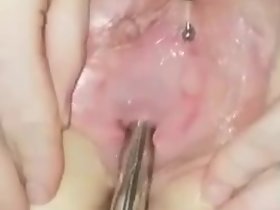 Sondeo de glacial uretra Penetración Doble